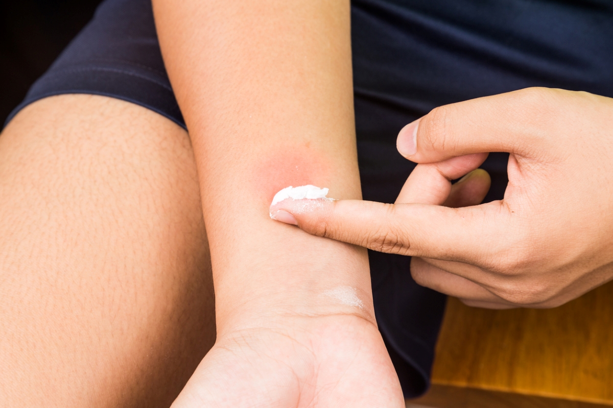 Person putting ointment on insect sting.